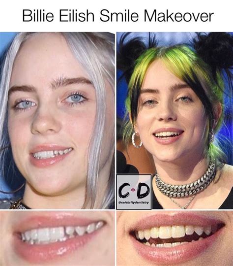 billie eilish invisalign braces.